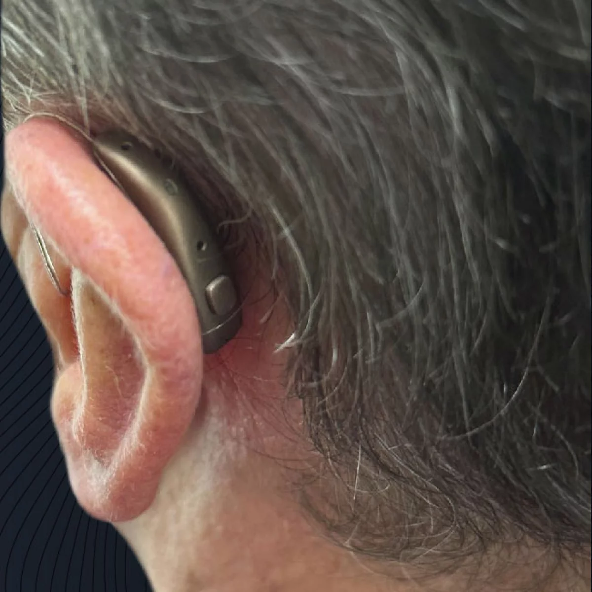 Hinter dem Ohr getragenes Hörgerät in Nahaufnahme​​​​​​